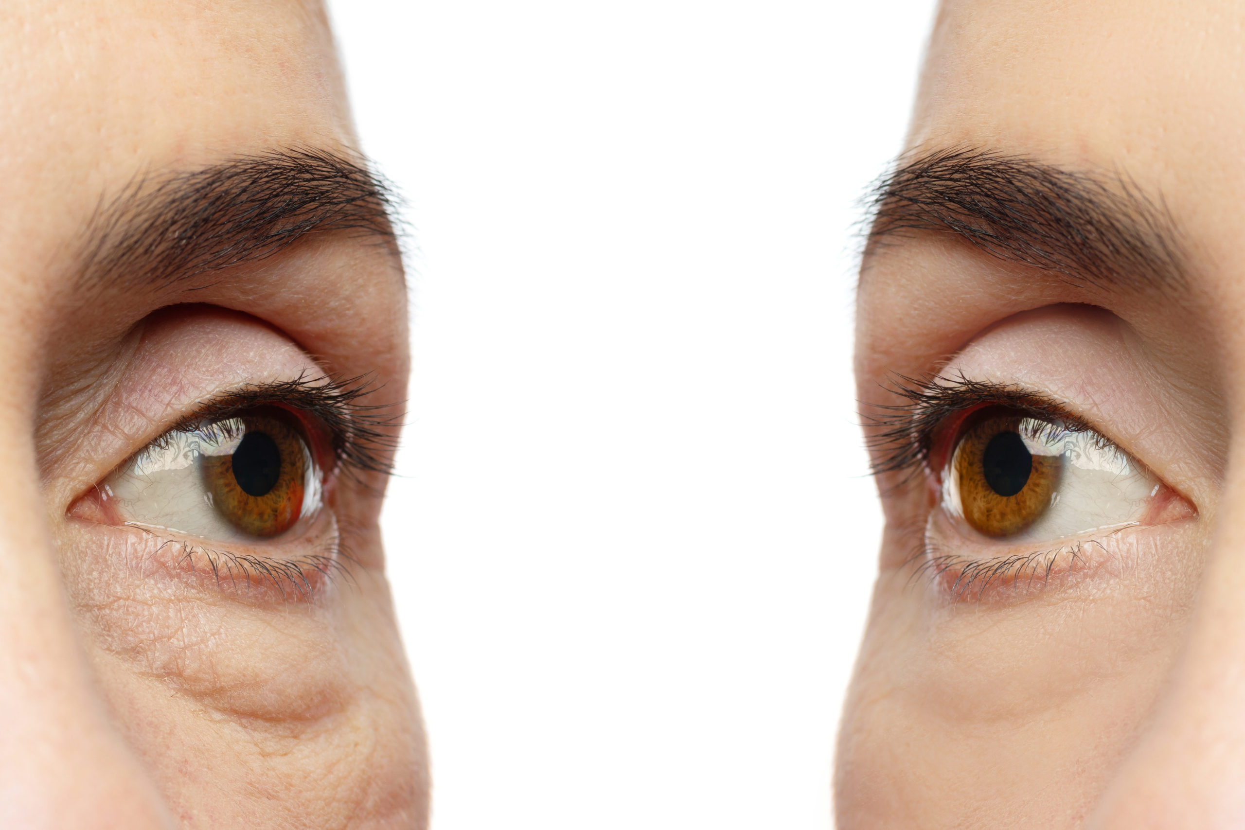 Cuidados a considerar luego de una blefaroplastia